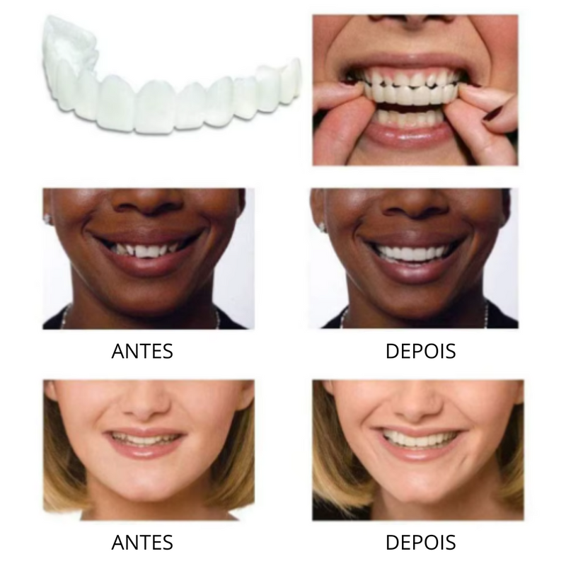 Facetas Dentarias Removíveis -PerfectSmile