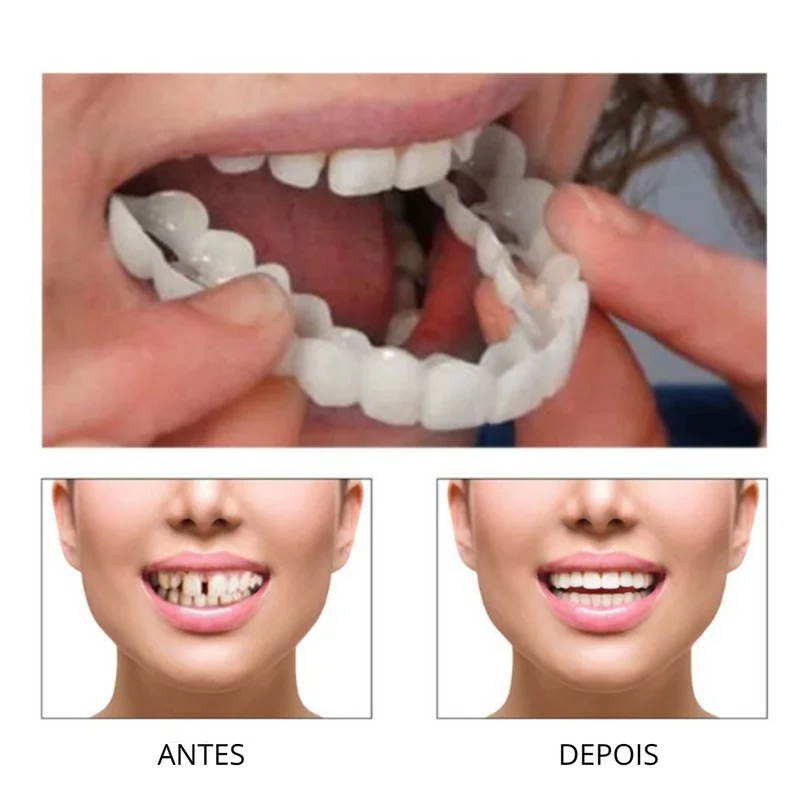 Facetas Dentarias Removíveis -PerfectSmile