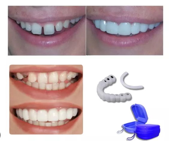 Facetas Dentarias Removíveis -PerfectSmile