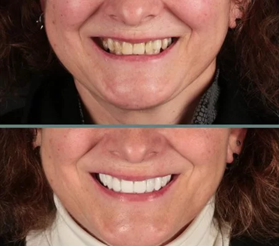 Facetas Dentarias Removíveis -PerfectSmile