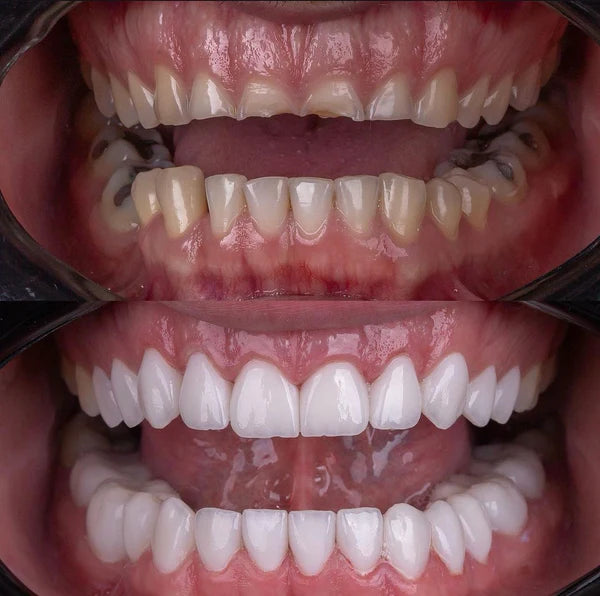 Facetas Dentarias Removíveis -PerfectSmile